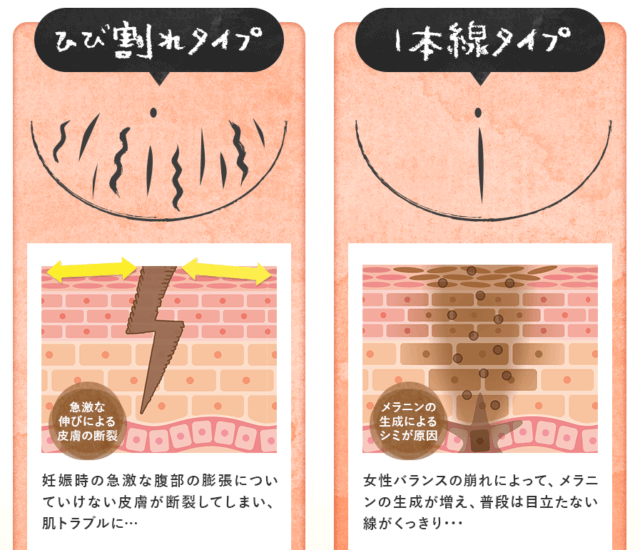 妊娠線と正中線の解説図